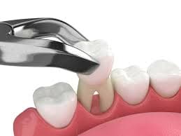 General Tooth Extractions in Fulton, NY - Fulton Dental Health