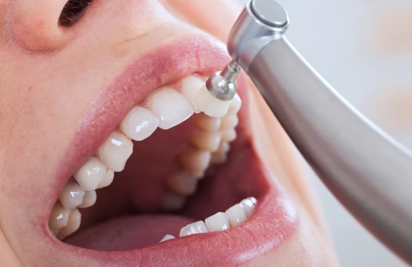 Fluoride Treatments in Fulton, NY - Fulton Dental Health